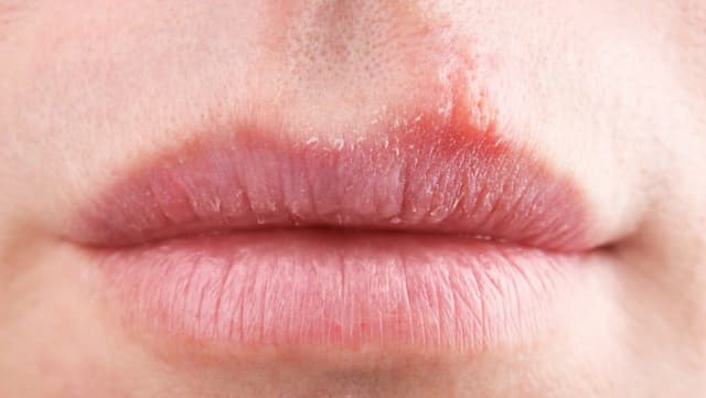Cold Sores 1