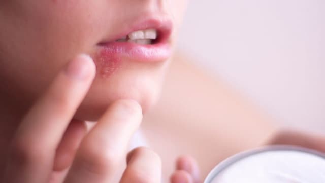 Cold Sores 3