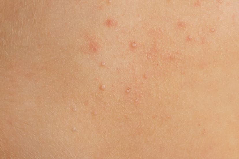 หูดข้าวสุก รักษายังไง ชวนดูสาเหตุ วิธีป้องกัน และการรักษา2