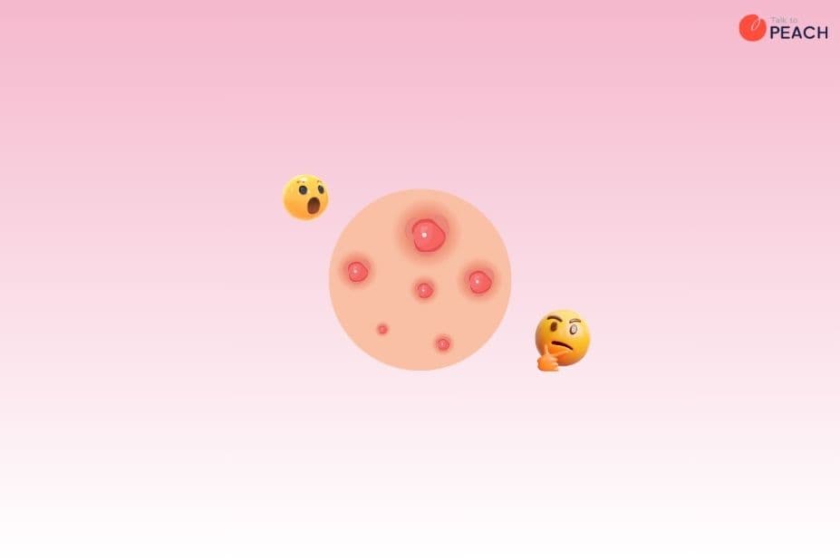 ตุ่ม PPE คืออะไร ดูยังไง สัญญาณเตือนทางผิวหนังเกี่ยวกับเชื้อ HIV